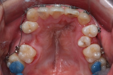 부산구순구개열