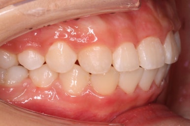 부산치아교정잘하는곳