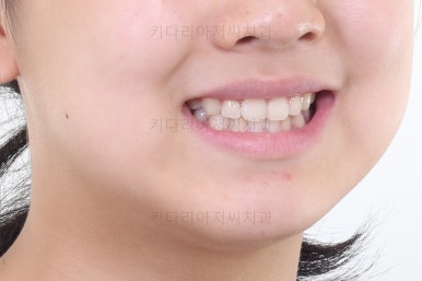 부산토끼치아교정