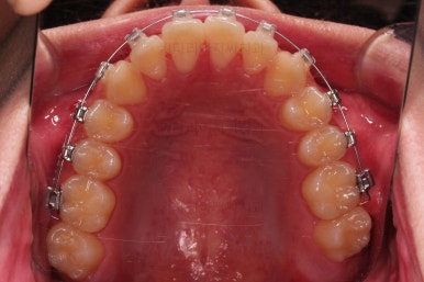 부산주걱턱교정