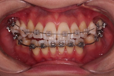 부산치아교정잘하는치과