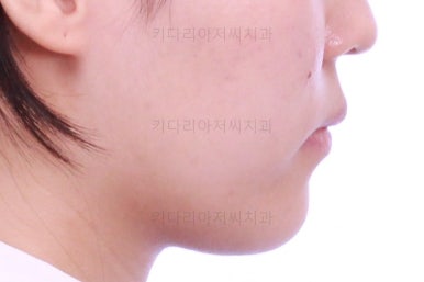 부산비발치교정