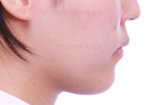 부산비발치교정