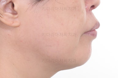 동래임플란트교정