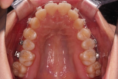 부산클리피씨교정