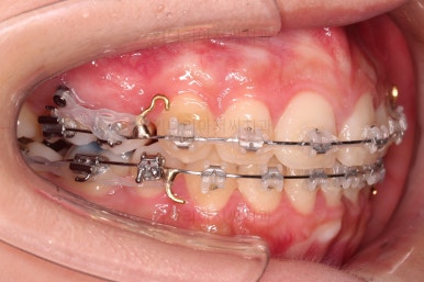 부산클리피씨교정