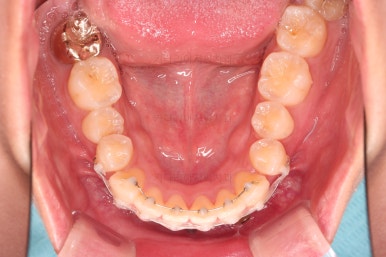 부산앞니부분교정