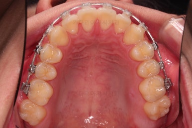 부산주걱턱교정