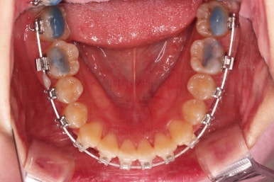 부산돌출입교정