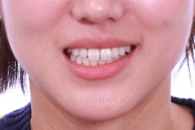 부산치아교정잘하는곳