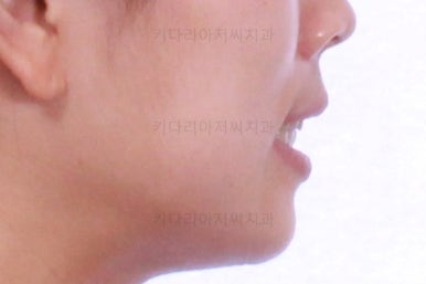 부산비발치교정