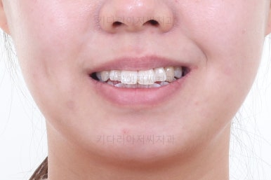 부산치아교정잘하는치과