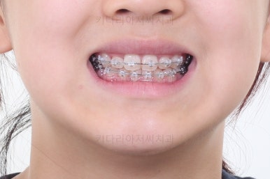 부산토끼치아교정