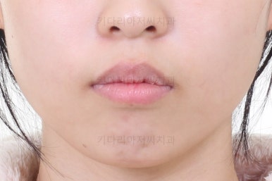 부산클리피씨교정