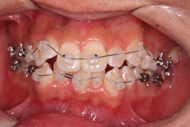 부산청소년치아교정