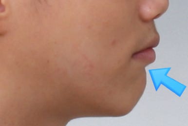 부산왜소치교정