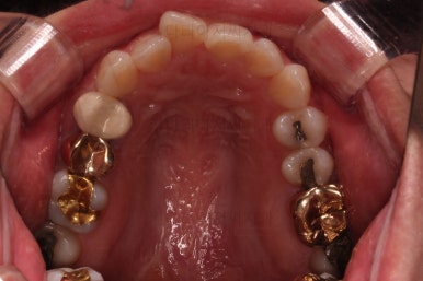 부산부분치아교정