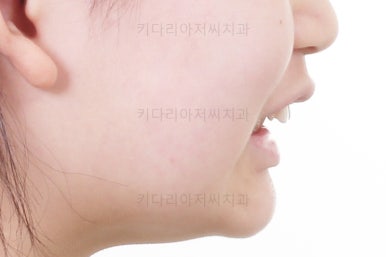 부산어린이치아교정