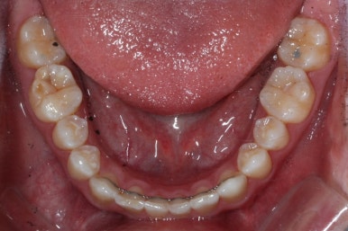 부산왜소치교정