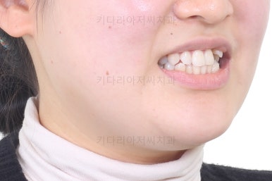 부산치아교정