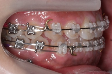 부산치아교정치과