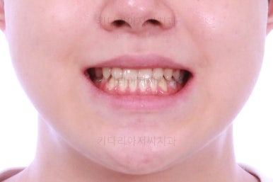 부산주걱턱교정