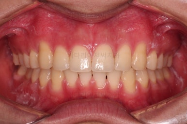 부산연산동치아교정