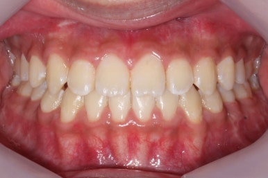 부산주걱턱교정