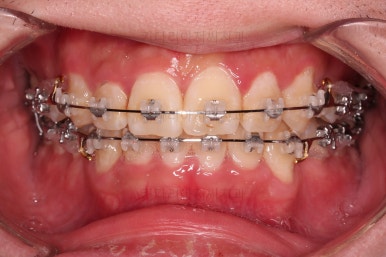 부산돌출입교정