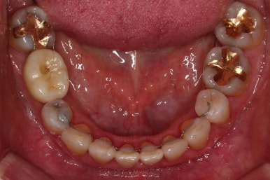 동래임플란트교정