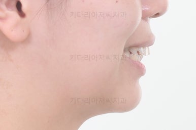 부산사랑니교정