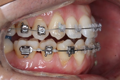 부산비수술교정