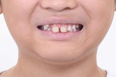 부산어린이돌출입교정