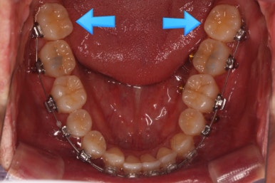 부산비수술교정