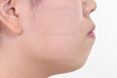 부산비발치교정