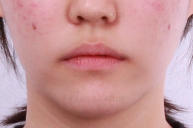 부산비발치교정