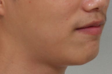 부산왜소치교정