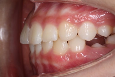 부산치아교정잘하는곳