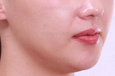 부산비대칭교정