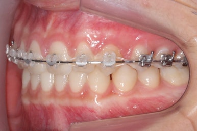 부산매복치아교정