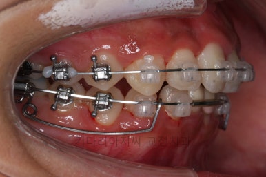 연산동치아교정