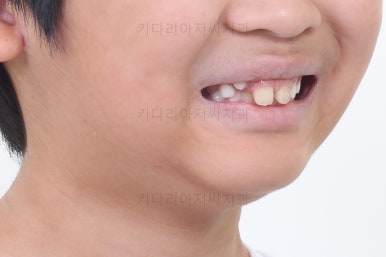 부산어린이돌출입교정