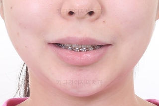 부산연산동교정치과