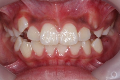 연산동덧니교정