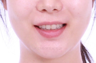 부산부분치아교정