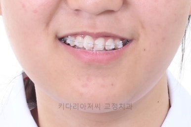 연산동치아교정