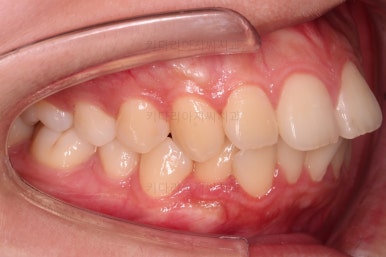 부산클리피씨교정