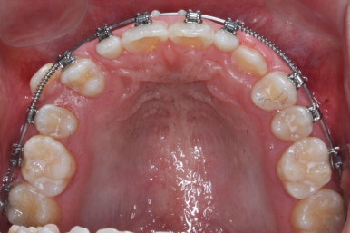부산왜소치교정