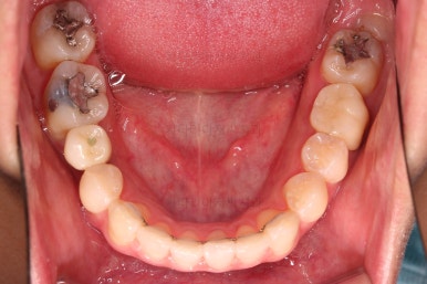 연산동치아교정
