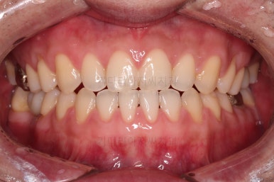 연산동임플란트